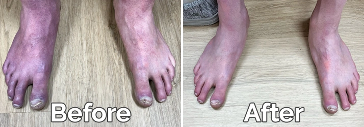 Neuropathy Davenport Iowa Feet Before And After Treatment